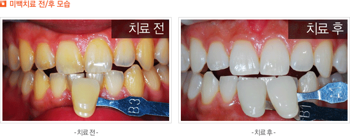 미백치료 전/후 모습